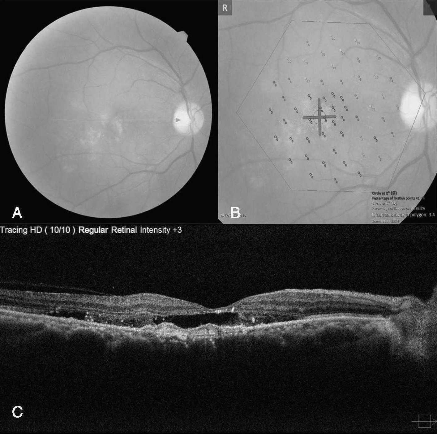 病例2-2-10 診斷:雙眼濕性AMD。